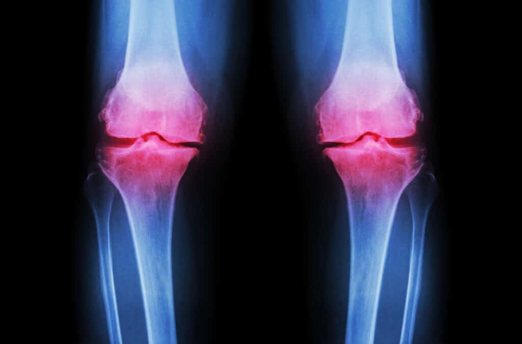 x-ray of knee with osteoarthritis
